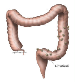 Colon with diverticulosis